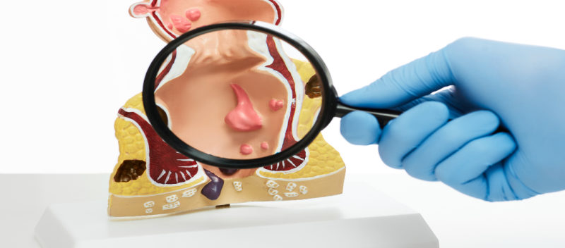 Piles (Hemorrhoids) laser treatment at Dr Ratnadip Shantaram Sonawane's clinic, Punawale